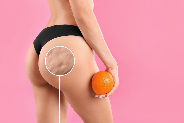 celulitis o piel de naranja