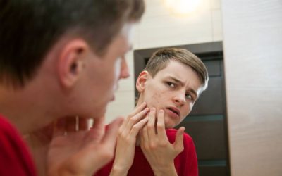 Tratamiento acné juvenil