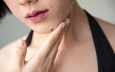 Cómo quitar verrugas de la cara