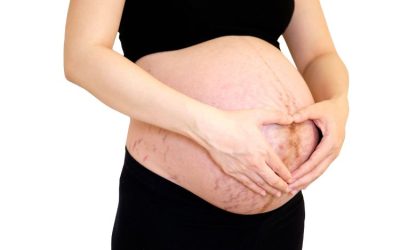 Estrías rojas tratamiento