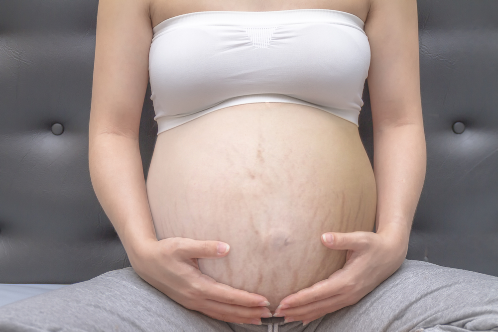 Cómo se tratan las estrías del embarazo