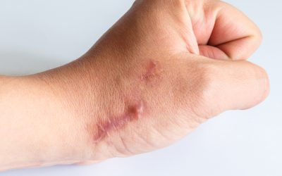 Cómo curar las cicatrices hipertróficas