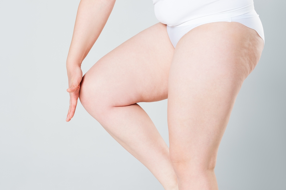 celulitis en piernas